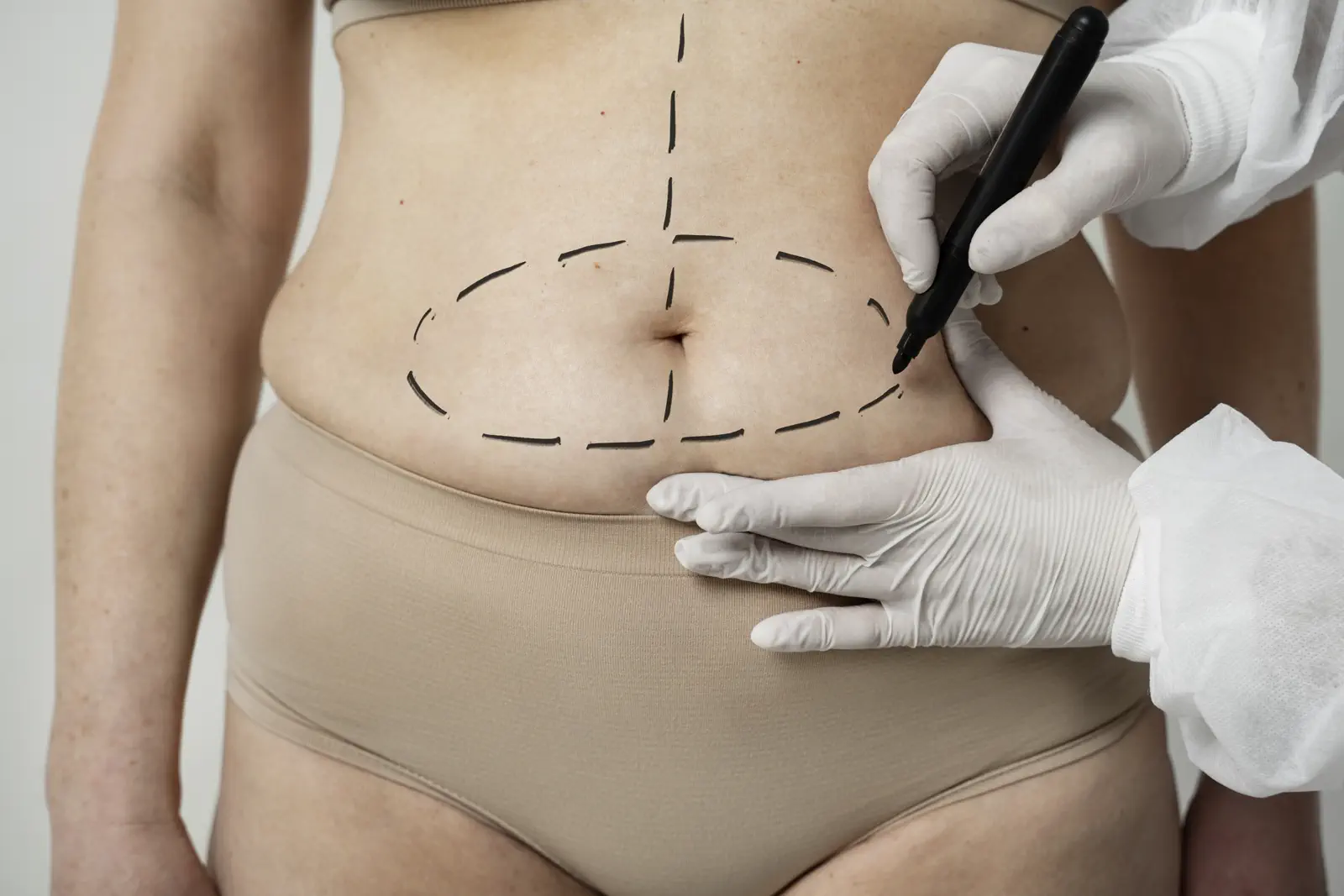 6 Ways to Get Rid of Scars and Stretch Marks
