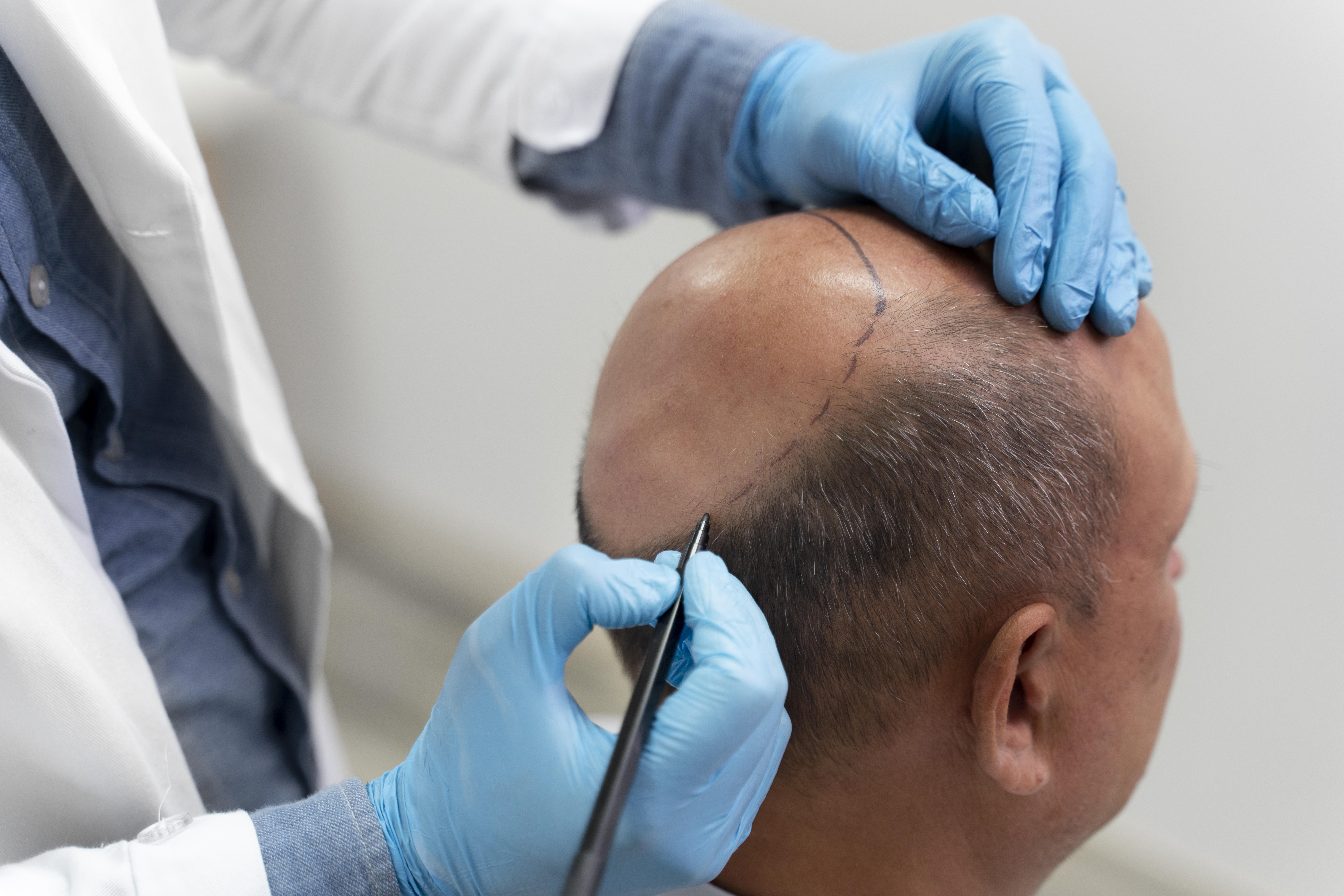Hair restoration treatment
